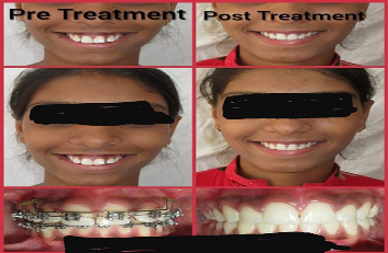 Dental Treatment Pre and Post