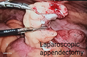 laparoscopic appendectomy