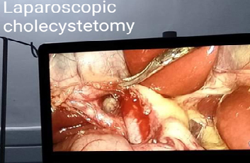 Laparoscopic Cholecystetomy