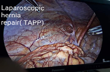 Laparoscopic Hernia Surgery