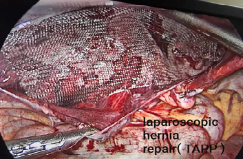 Laparoscopic Hernia Repair
