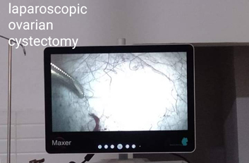 Laparoscopic Ovarian Cystectomy
