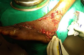 leg-surgery